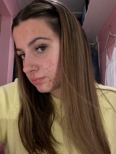 Customer photo review of Pre-Wash Fortifying Rosemary Oil for Scalp