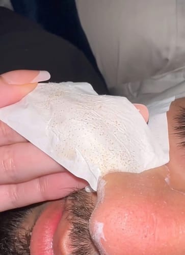 Customer photo review of Deep Cleansing Patch System11 (Copy)