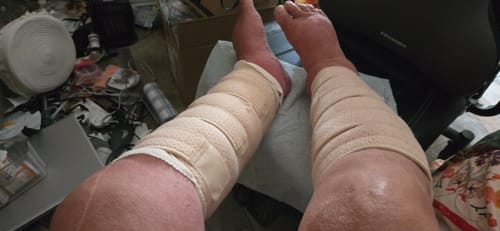 Customer photo review of Beltwell® Adjustable Calf Compression Wrap For Very Swollen Legs (1 wrap)