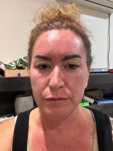 Customer photo review of *NEW* Dr. Pen A11 Ultima PRO Microneedling Pen