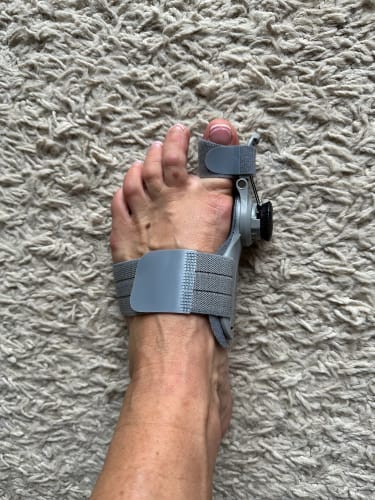Customer photo review of 👣 Bunion Brace Corrector – Walk Without Pain
