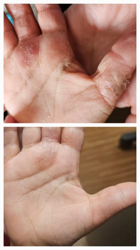 Customer photo review of Ultra-Fast Relief Balm for Dry, Itchy Skin – For Body & Face