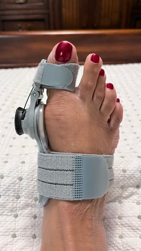 Customer photo review of Treatmedy™ Bunion Fix - Natural At-Home Bunion Relief