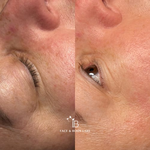 Customer photo review of *NEW* Dr. Pen A20 Advanced Microneedling Pen for Professionals