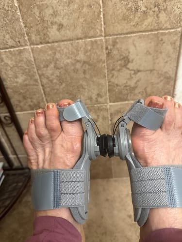 Customer photo review of Treatmedy™ Bunion Fix - Natural At-Home Bunion Relief