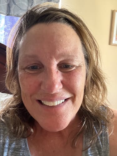 Customer photo review of Pop On Veneers with Impression Kit