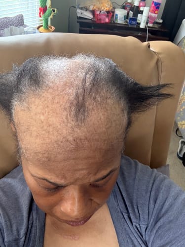 Customer photo review of Rennora Hair Growth Serum