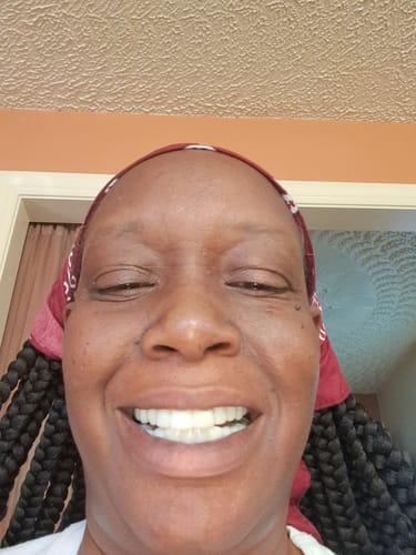 Customer photo review of Pop On Veneers with Impression Kit