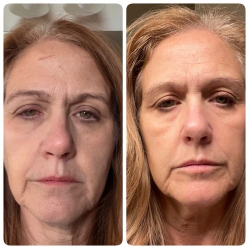Reviewer's side-by-side photo showing skin before (right) and after (left) using the Seranova Micro Infusion System.