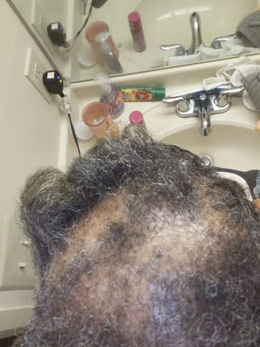 Close-up of a customer's crown showing a significant area of thinning hair and visible scalp.