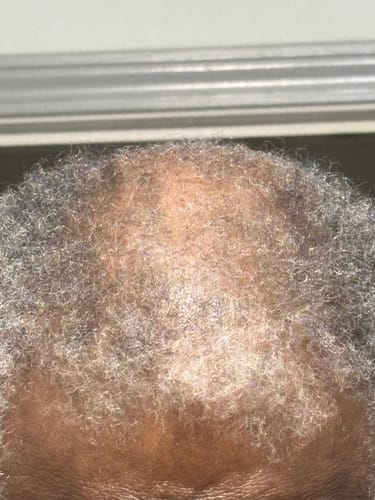 Close-up of a reviewer's scalp showing thin, curly grey hair after using Rennora Hair Growth Serum.