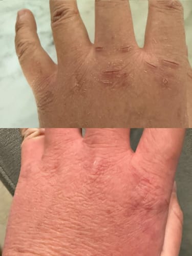 Customer photo review of Eczema Scratch Mitten