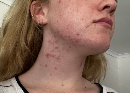 Close-up of a reviewer's cheek and neck showing widespread red acne before starting the Advanced Acne Program™.