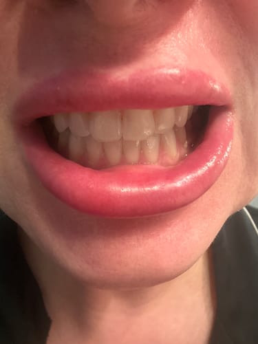 Customer photo review of 3+1 ZADARMO LYSS zubné kefky - výhodné rodinné balenie