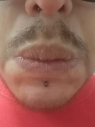 Customer photo review of ReBeard רולר לצמיחת זקן