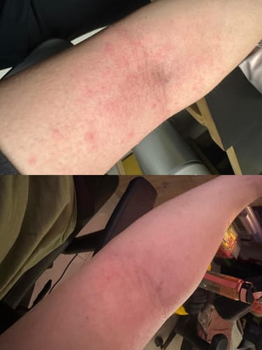Customer photo review of Eczema Scratch Mitten