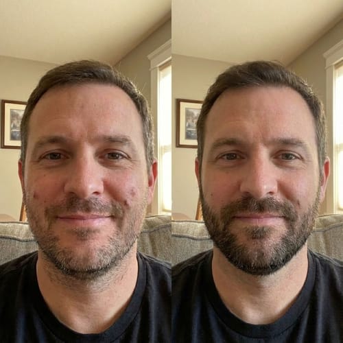 Customer photo review of ReBeard רולר לצמיחת זקן