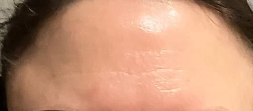 Customer photo review of ScarRelief™ | Silikon-Narbenpflaster gegen Falten