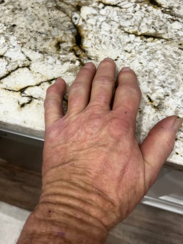 Customer's hand before using the Onecompress gloves, showing a noticeably bent and swollen little finger.