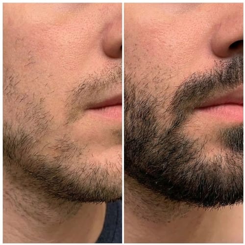 Customer photo review of ReBeard רולר לצמיחת זקן