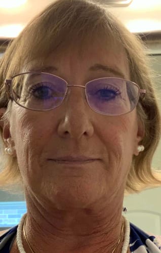 Reviewer's face showing firmer skin after using the Seranova Micro Infusion System.