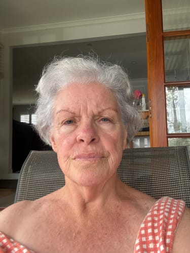 Reviewer showing their smooth facial skin after using the Seranova Micro Infusion System for 6 weeks.