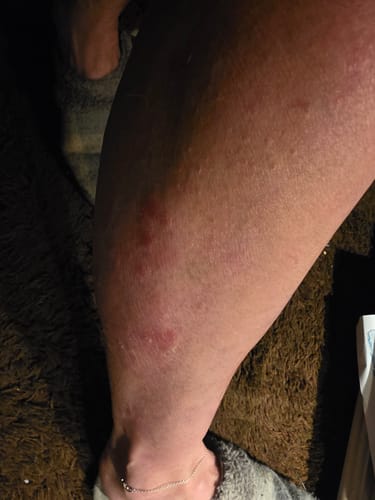 Close-up of a reviewer's leg showing a subsided psoriasis flare-up after using Multi Strain Biotic.