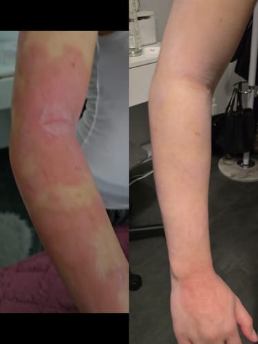Customer photo review of Eczema Scratch Mitten