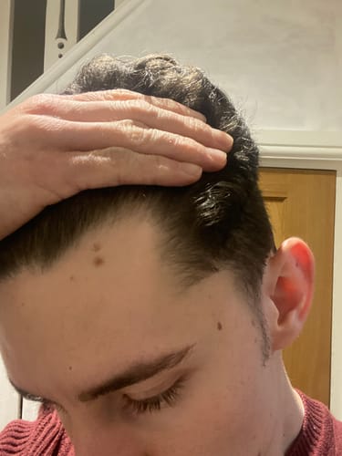 Customer photo review of Maximum Strength Hair Complex | Natural DHT Blocker