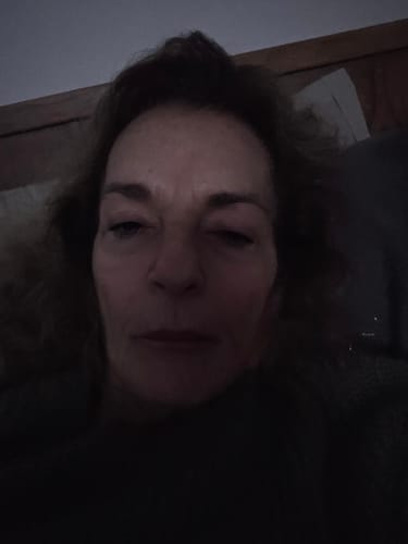 Close-up of a reviewer's face, showing their skin condition after using the Seranova Microneedling Infusion System.