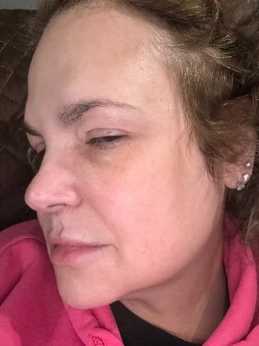 Close-up of a reviewer's face showing skin results after using The Micro Infusion System.