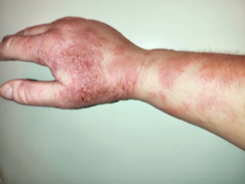 A vásárló gyulladt, ekcémás bőre a kézfején, a SERENI krém használata közben.