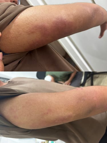 Customer photo review of Eczema Scratch Mitten