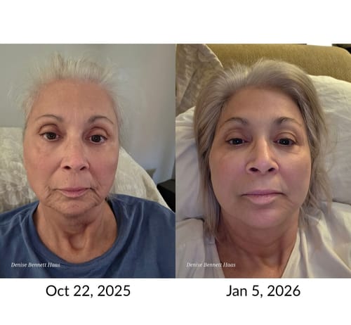 Customer photo review of JOVS 4D Laser Anti-Aging Therapy Mask