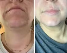 Customer photo review of Dr.Melaxin Peel Shot Glow Rice Ampoule Duo