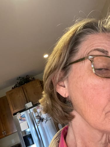 Close-up of a reviewer's face, showing skin results on her cheek after using the Seranova Microneedling Infusion System.