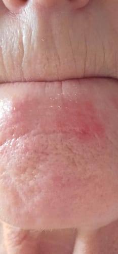 Customer photo review of Seb Natural Calming Serum