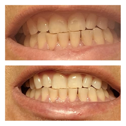 Customer photo review of PAP+ bieliace pásiky na zuby (10 aplikácií)