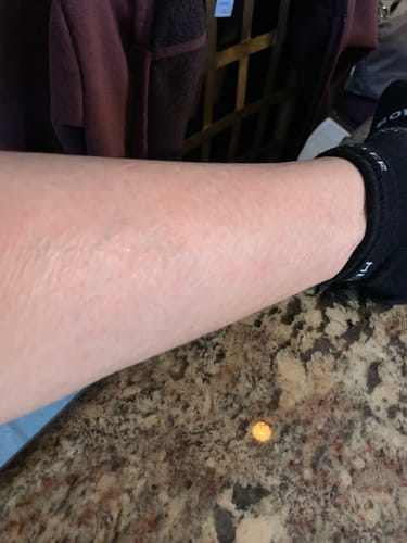Customer photo review of EczPro - Probiotics for Eczema, Natural Remedy, 13 Histamine-Safe Strains, Allergen-Free Formula