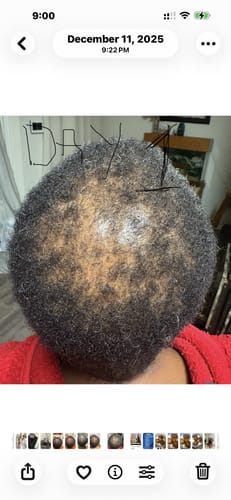 Customer's scalp on day 14 of using the Scalp Stimulator, showing short hair with visible thinning at the crown.