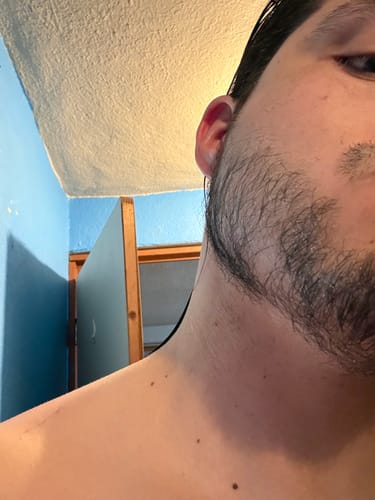 Customer photo review of Bálsamo Mélamus - Minoxidil 20%