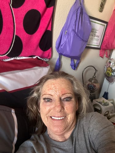 Reviewer smiling, showing healing skin with some redness on her forehead after using the Tallow & Honey Balm.