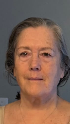 Reviewer's close-up showing smoother skin after using The Micro Infusion System.