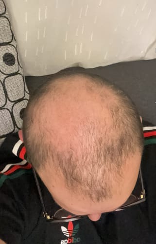 Vue de dessus du crâne d'un client avec une perte de cheveux visible avant d'utiliser le Pack d'Odin.