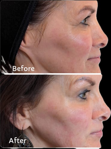 Customer's before-and-after image showing reduced fine lines around the eyes and cheek after using The Micro Infusion System.