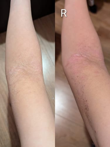 Customer photo review of Eczema Scratch Mitten