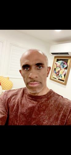 Reviewer showing significant hair loss before using Rennora Hair Growth Serum.