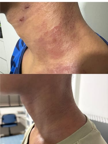 Customer photo review of Eczema Scratch Mitten