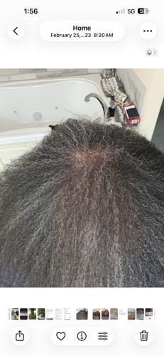 Customer's scalp with dark, thinning hair showing a bald spot on the crown before using Rennora serum.