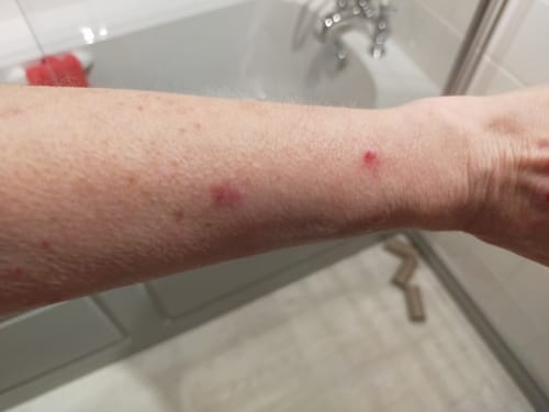 Reviewer's arm showing healing skin with some red marks after using the Soothing Spray.